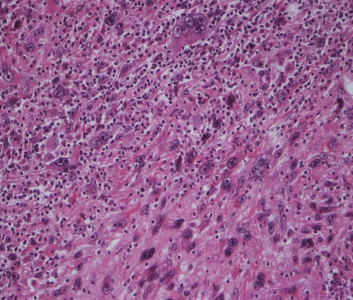 Finner tumor i venstre atrium, 37 mm. Ekstirpasjon av tumor med myxom-liknende utseende Makroskopisk undersøkelse: Et glass med to atrieresektater.