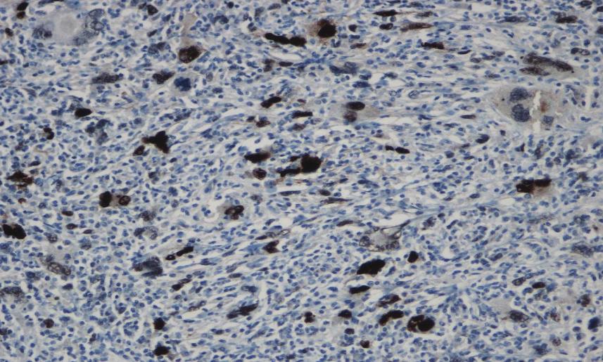 4: Snitt fra det mindre resektatet uten makroskopisk tumor Rest. 30 Immunhistokjemisk undersøkelse er vanskelig å tolke pga stor inflammatorisk komponent. Tumorcellene viser amplifikasjon av MDM2.