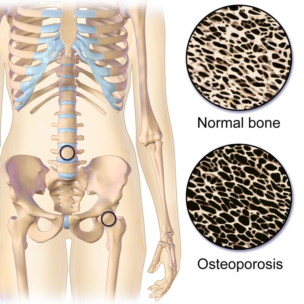 Lavenergibrudd Vanligste osteoporosebrudd er brudd
