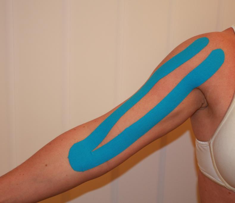 Bicepstendinitt En senebetennelse i biceps oppstår etter en akutt eller langvarig overbelastning av bicepsmuskelen.