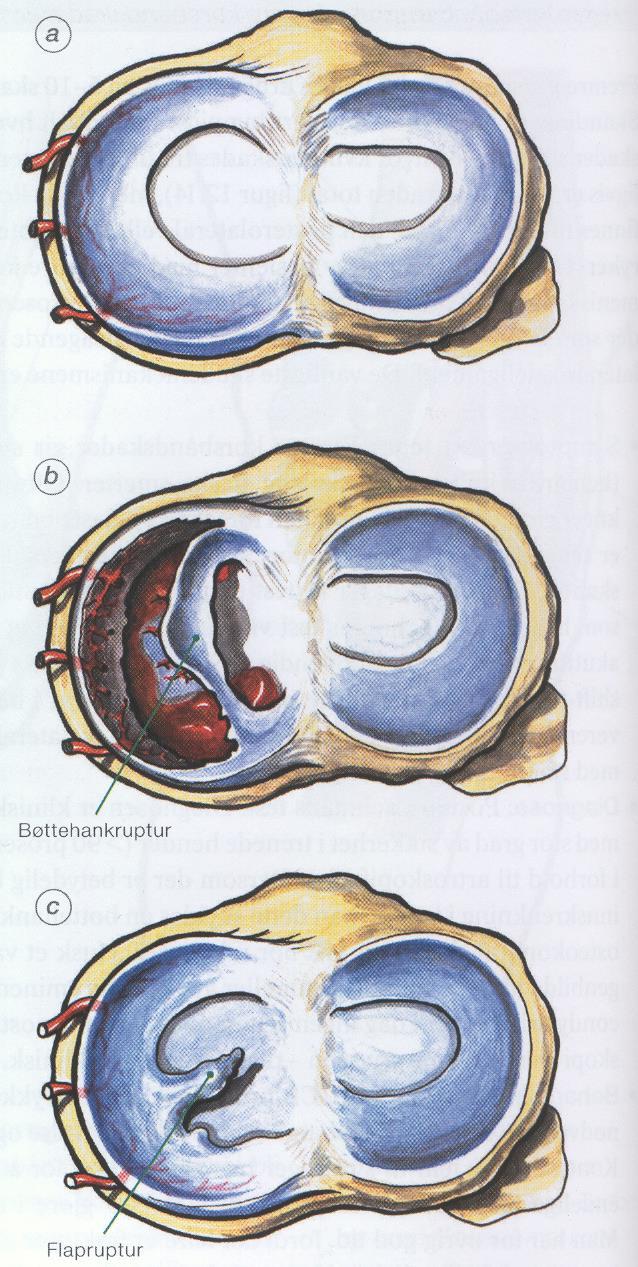 BB Meniskskader Menisken er støtdemperen i kneet. I tillegg hjelper de ligamentene med stabilitet av kneet. Meniskskader kan opptre isolert eller sammen med ligamentskader.
