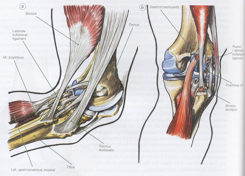 Skader i sideleddbånd kne Mediale ligamentskader Skademekanismen er oftest at kneet tvinges i valgus mens det er lett flektert. F.eks. når en motstander faller over en annen spiller.