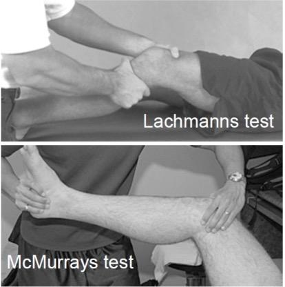 McMurrays prøve er en prøve på meniskskade. Pasienten ligger på ryggen, undersøkeren holder rundt foten med den ene hånden og med den andre palperes mediale leddspalte.