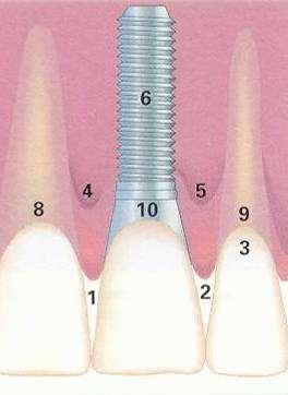 5 1) Mesial papilla 2) Distal papilla 3) Marginal gingiva 7 4) Mesial intercrestal bein 5) Distal intercrestal bein 6)