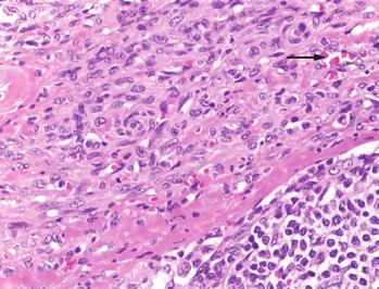 Begge biopsiene viste HHV-8-positivitet (humant herpesvirus 8). Lymfeknutebiopsien fra fem år tidligere ble revurdert til også å være forenelig med Kaposis sar kom (fi gur 3).