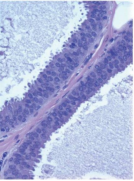 Flat epitelial atypia (FEA) Sylinderepitelial lesjon stratifisering av celler cytologisk atypi simpel kompleks arkade, bro, papille
