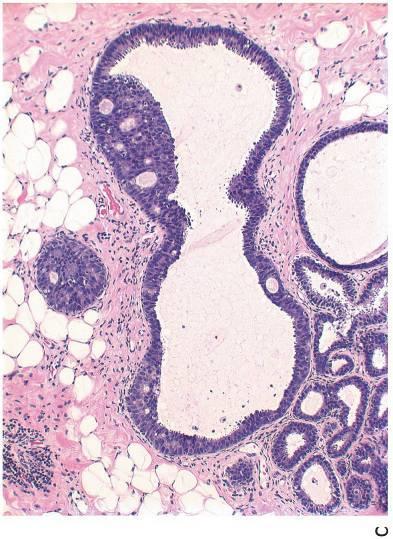 ADH/DCIS Sylinderepitelial lesjon stratifisering av celler cytologisk atypi simpel kompleks arkade, bro, papille