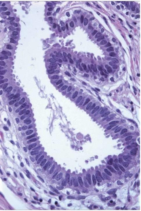 Columnar cell change (CCC) Sylinderepitelial lesjon stratifisering av celler cytologisk atypi simpel kompleks arkade, bro, papille