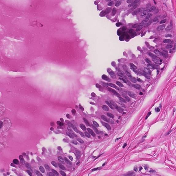 Columnar cell hyperplasia (CCH) Sylinderepitelial lesjon stratifisering av celler cytologisk atypi simpel kompleks arkade, bro,