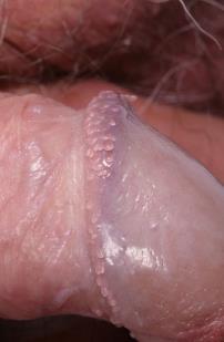 Pearly penile papules-spiculae glandis, penile paplar, Vestibulær papillomatose MSM kva prøvar bør takast