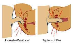 VAGINISME Ufrivillig kontraksjon av muskultaturen