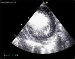 metode MR/CT/ventrikulografi 26 IVNC vs HCM: EF