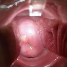 Cervix Ovula Nabothi
