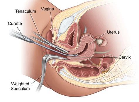 Sett inn selvholdende spekulum slik at cervix er godt synlig. Tørk bort slim og rester av eksplorasjonsgel.