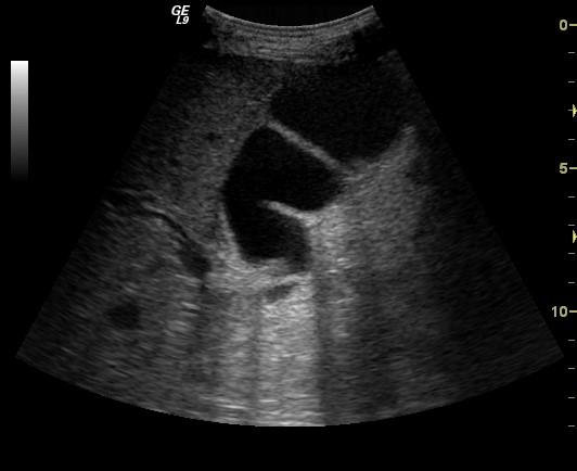 Folded Gallbladder