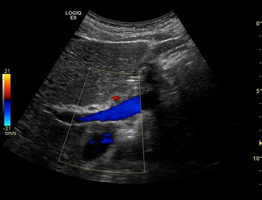 Diameter ductus hep.