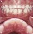 Dental erosjon. Moderne tannslitasje og ny folkesykdom