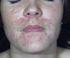 Akne, Rosacea, Perioral dermatitt