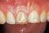 Resultatet av endodontisk behandlede tenner ved en Universitetsklinikk: En sammenligning over 20 år