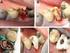 Temporære materialer og lekkasje i forbindelse med endodontisk behandling