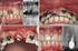 Har det marginale bennivået betydning for den endodontiske prognosen til rotfylte tenner?