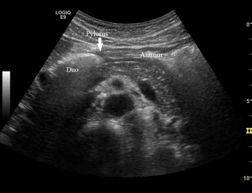 Stasjon 1-6 -Stasjon 1 Transversalsnitt i epigastriet Bruk kjente anatomiske landemerker til