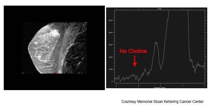 MRS Mamma Ingen Cho sees: Benign fibrocystisk endring 85 100% spesifikt