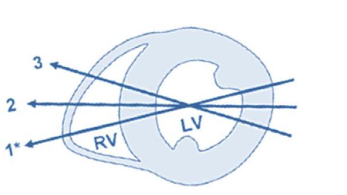 HVfokusert Midt-kavitær diameter (RVD2) 19-35mm maksimal