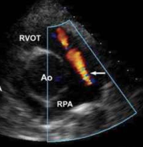 Parasternal kortakse RVOT/Pulmonalklaff stenose/insuffisiens Art.