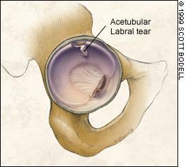 Hofteimpingement Femoroacetabulær innklemning Etiologi Acetabular labrumskade, oftest yngre Ofte medfødt eller ervervet benderformitet Løst legeme/corpus librum (med eller uten artrose) To typer