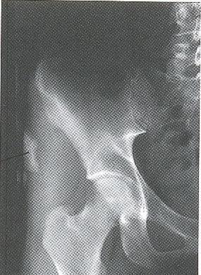 Isometrisk fleksjon Diff.diagnoser Smerter M rectus femoris tendinopati (isom. kneext.