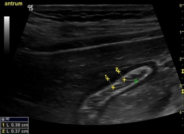 Distal del: Epigastriet.