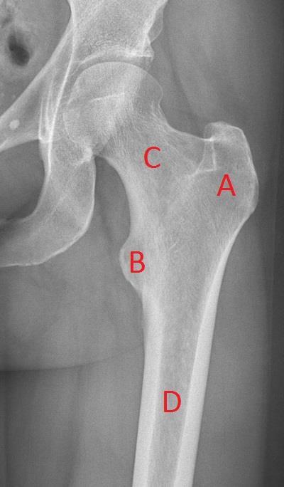13 av 16 vignett til spørsmål 2 Spørsmål 2 (2 På grunn av smertene i venstre hofte, blir det også tatt røntgenbilde av hoften.
