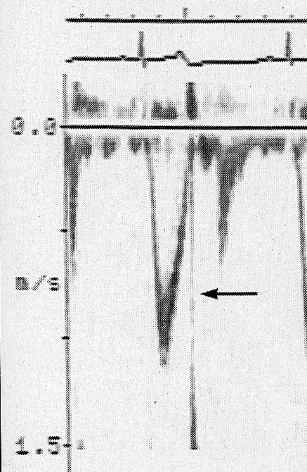 Minuttvolum ved Doppler VTI - velocity time integral v A