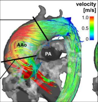 MR kvantifisere flow Phase-contrast Aorta ascendens Velocities Area (ROI) Time Total forward volume = 162 ml Total backward volume = -59 ml RF = 36% Myerson, JACC 2018 MR kvantifisere flow