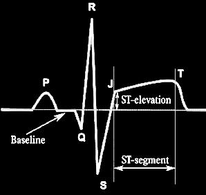EKG-forandringer ved STEMI ST-hevning: Indikerer
