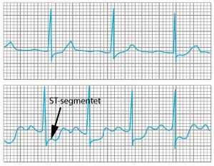 EKG-forandringer I ST-senkning: Tegn på iskemi,