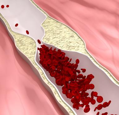 Akutt koronarsyndrom - fysiologi Ruptur/erosjon av plakket i åreveggen Blodplater strømmer til Blodpropp/trombose i åren Figur: www.