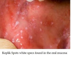 Barnevaksinasjonsprogrammet Meslinger (Morbilli) Virussykdom Smittes -> 10-14 dager: