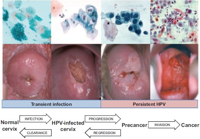 kontakt (kondom beskytter delvis) HPV-infeksjon -> Kreft i