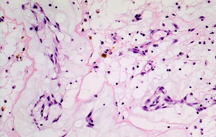 Kardialt myksom sjelden, benign tumor insidens 0,5-1/1 Mio/år 60-70% av primære hjertetumores oftest (70-80 %) i venstre atrium rikelig myksoid amorf