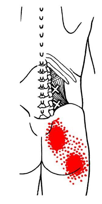 Quadratus lumborum