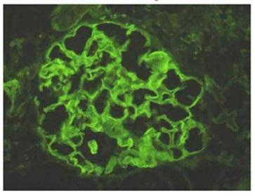 15 Anti-GBM I Indirekt Immunfluorescens: Hva ser man på bildet?