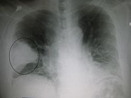 Pneumoni hos eldre Luftveisinfeksjoner utvikler seg oftere til pneumoni hos eldre Kolspasienter er utsatte for gjentatte