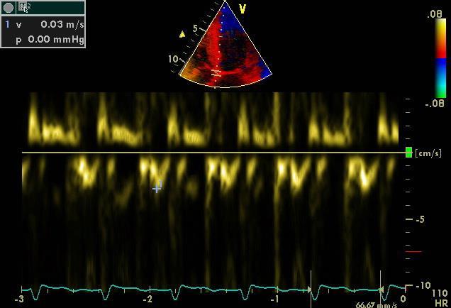 Pulset vevsdoppler i mediale mitralring Konstriksjon Restriksjon E` > 8 cm/s (pulset