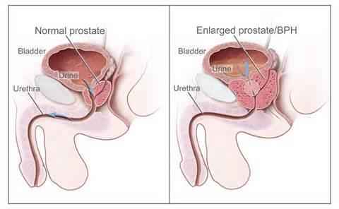 Risikofaktorer hos eldre Genital descens (genitalt fremfall) Postmenopausal