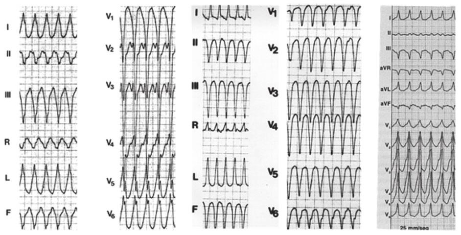 ESC Guidelines 15 Antidromic AVRT VT with negative concordance VT with positive concordance Figure 3 Examples of positive and negative chest lead concordance in VT AVRT = atrioventricular re-entrant
