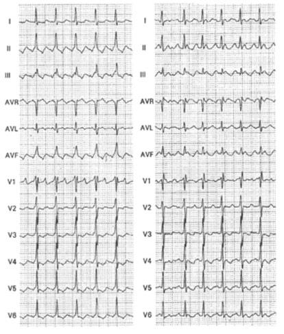 24 ESC Guidelines 1113 Multifocal atrial tachycardia Multifocal AT is defined as a rapid, irregular rhythm with at least three distinct morphologies of P waves on the surface ECG Multifocal AT is