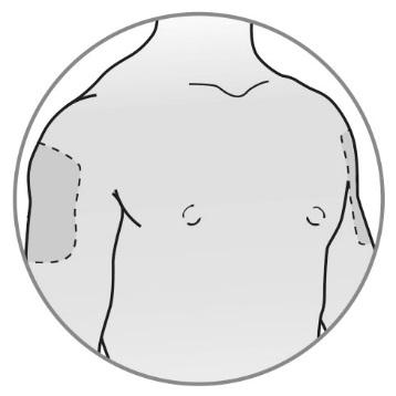 Trinn 4: Velg og klargjør injeksjonsstedet Velg et injeksjonssted i enten magen, forsiden av lårene eller ytre overarm (kun dersom omsorgspersonen administrerer).