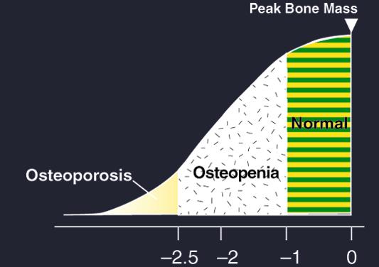WHO definisjon basert på BMD-måling Normal beintetthet: T-score 1,0 Osteopeni: T-score mellom 1,0 og 2,5 Osteoporose: T-score 2,5 Etablert osteoporose: T- score 2.